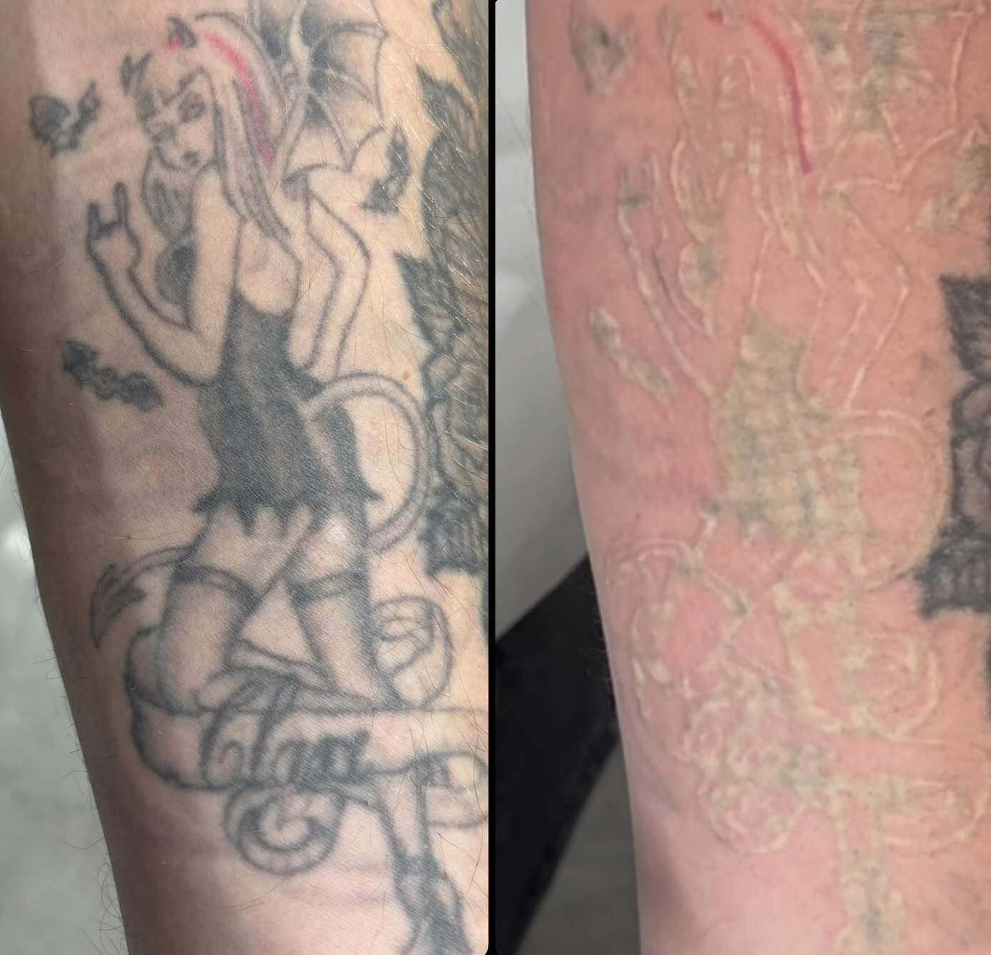 Side-by-side Close-up of a Tattooed Forearm — Laserpro Tattoo Removal in Wollongong, NSW