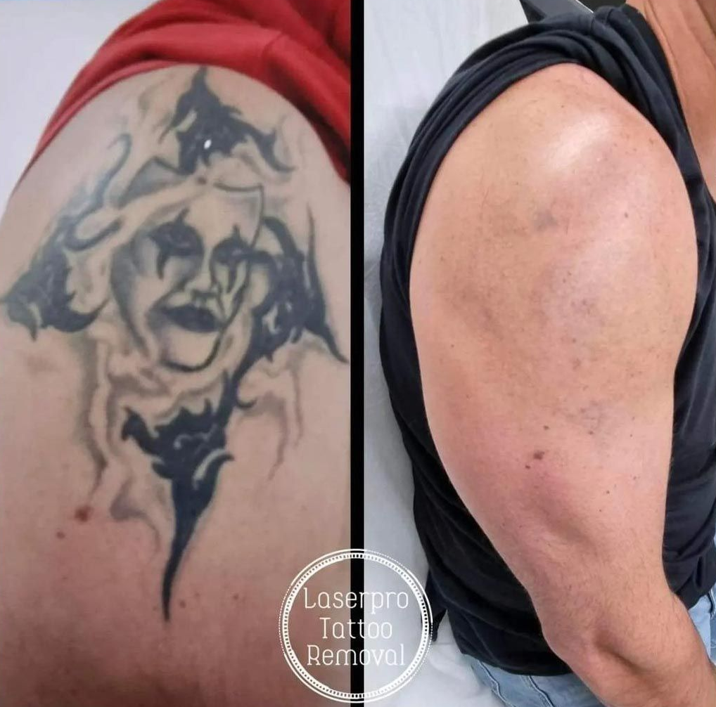 Before-and-after of an Upper Arm Tattoo Removal — Laserpro Tattoo Removal in Shellharbour, NSW