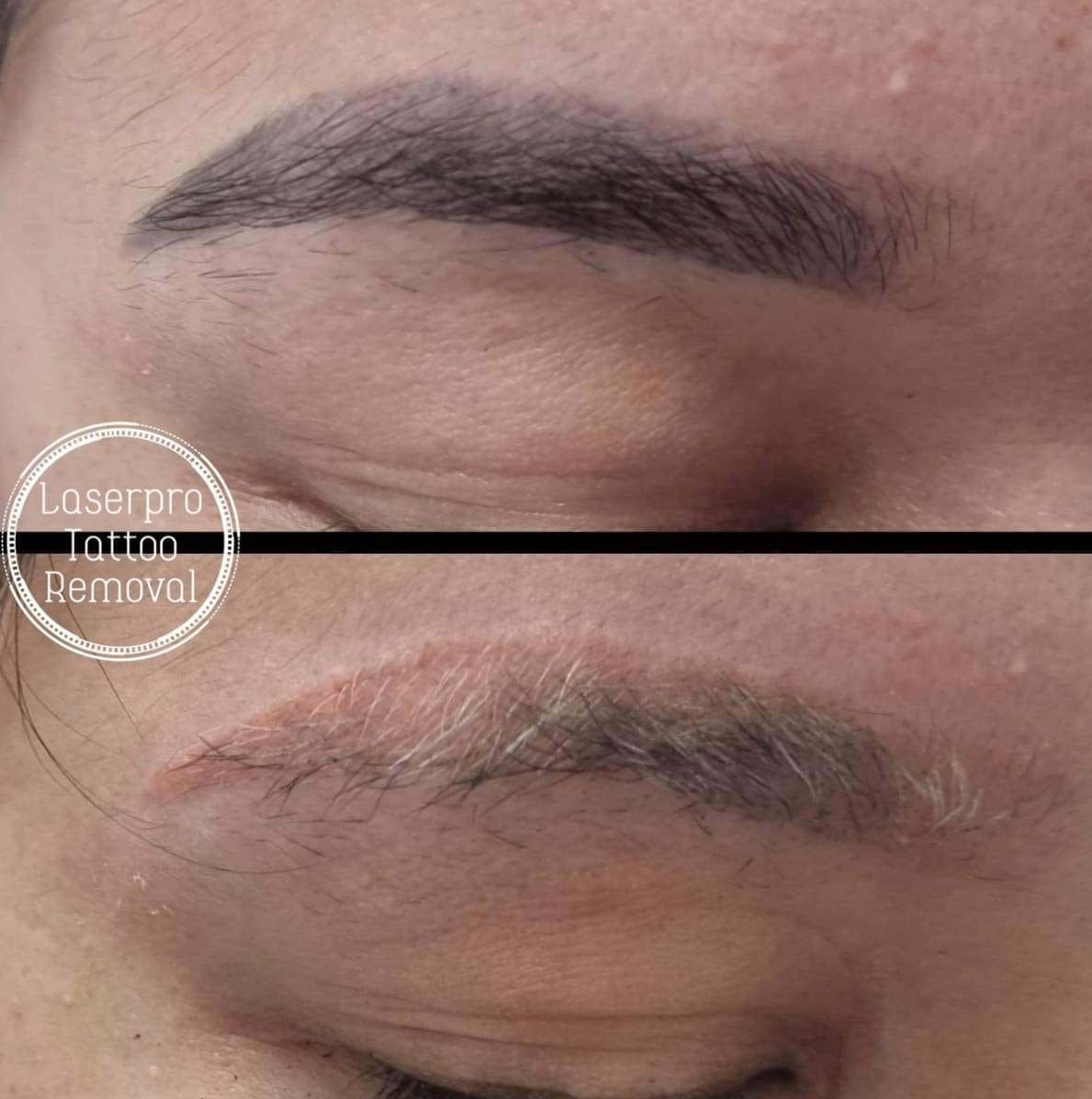 Before-and-after Close-up of an Eyebrow — Laserpro Tattoo Removal in Shellharbour, NSW