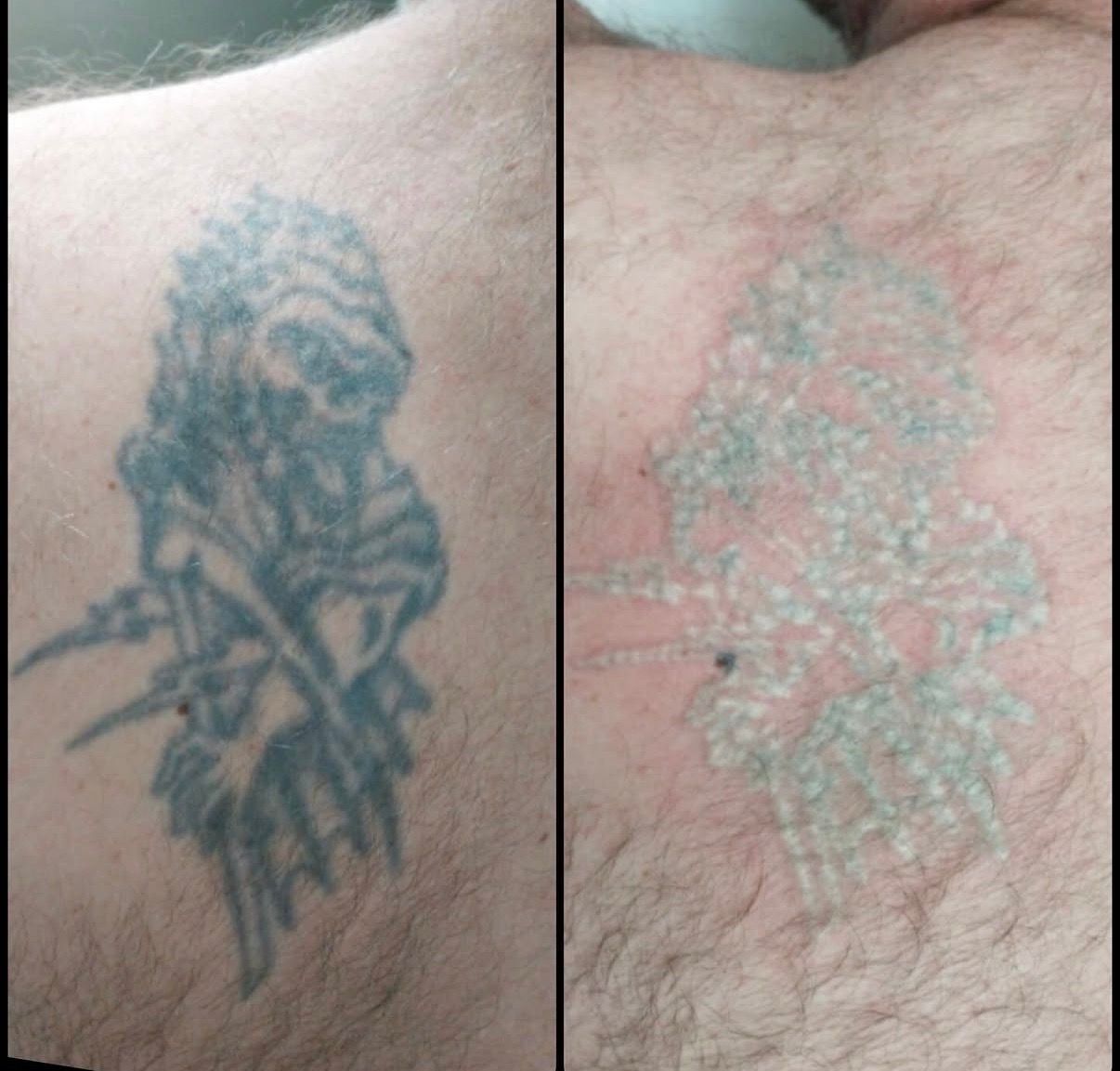Side-by-side close-up of a faded tattoo before and after laser removal on skin — Laserpro Tattoo Removal in Shellharbour, NSW