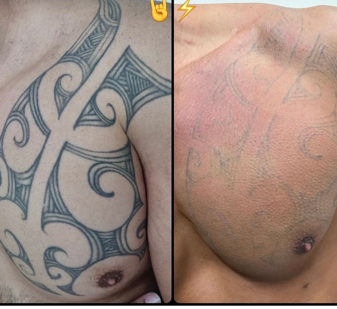 Before-and-after close-up of a chest tattoo: dark tribal design on the left, faded skin on the right. — Laserpro Tattoo Removal in Shellharbour, NSW