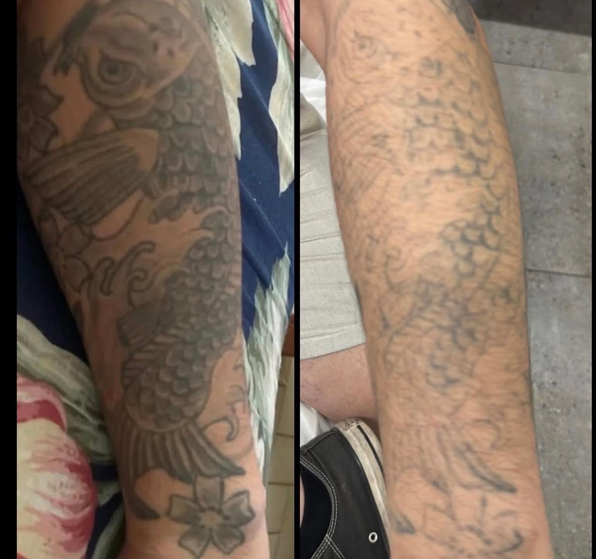 Side-by-side close-up of two tattooed forearms, one with darker ink and one with faint outline tattoos. — Laserpro Tattoo Removal in Shellharbour, NSW