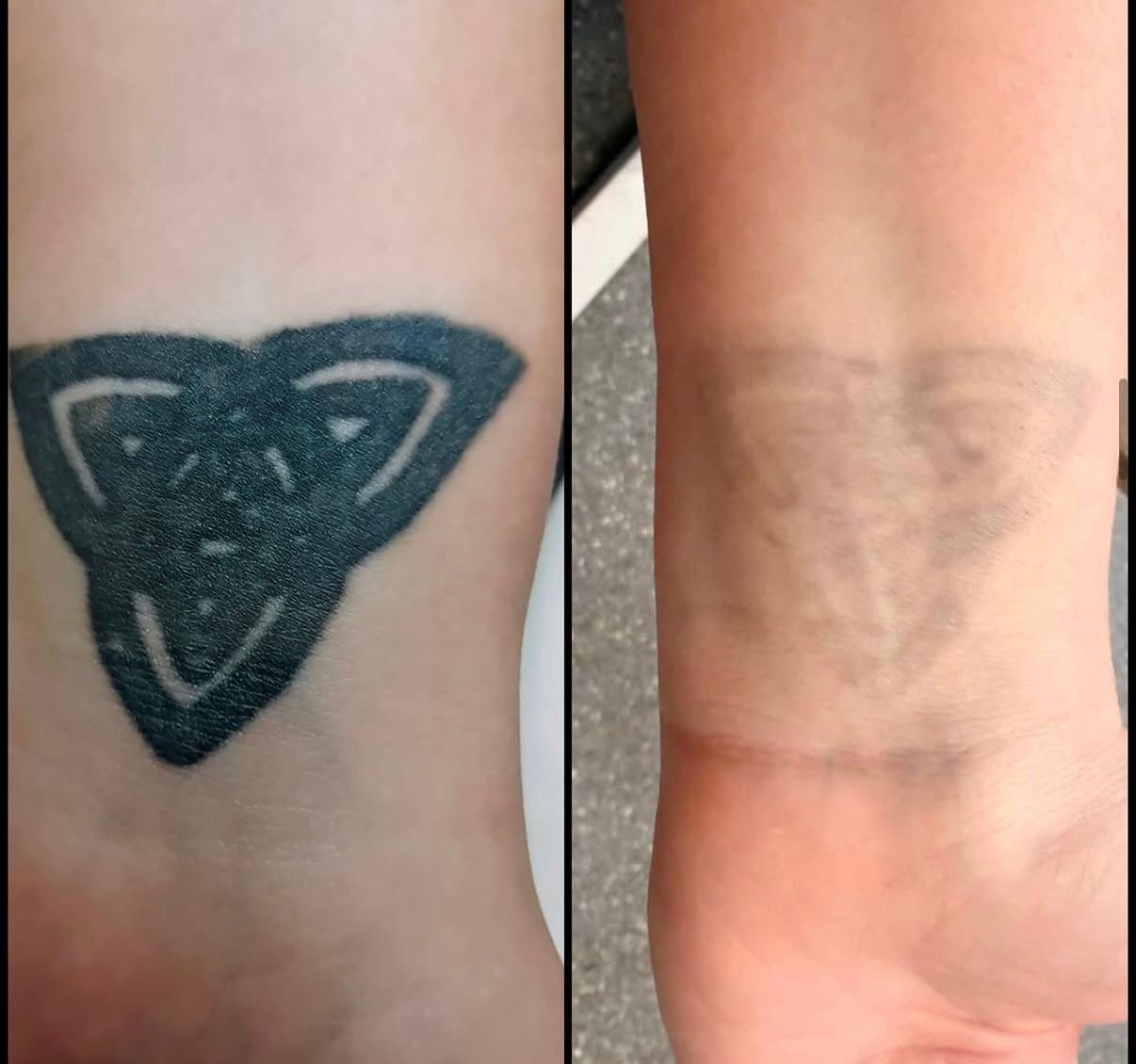 Side-by-side close-up of a dark tattoo before and after fading into a faint skin-toned outline — Laserpro Tattoo Removal in Shellharbour, NSW