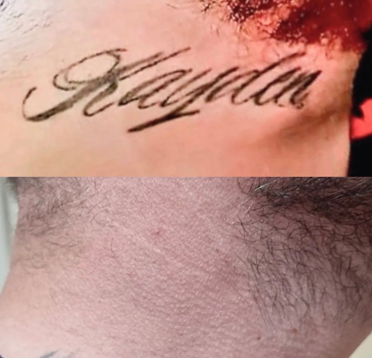 Close-up of a fresh black cursive tattoo with redness and blood on skin, above an uninked patch. — Laserpro Tattoo Removal in Shellharbour, NSW