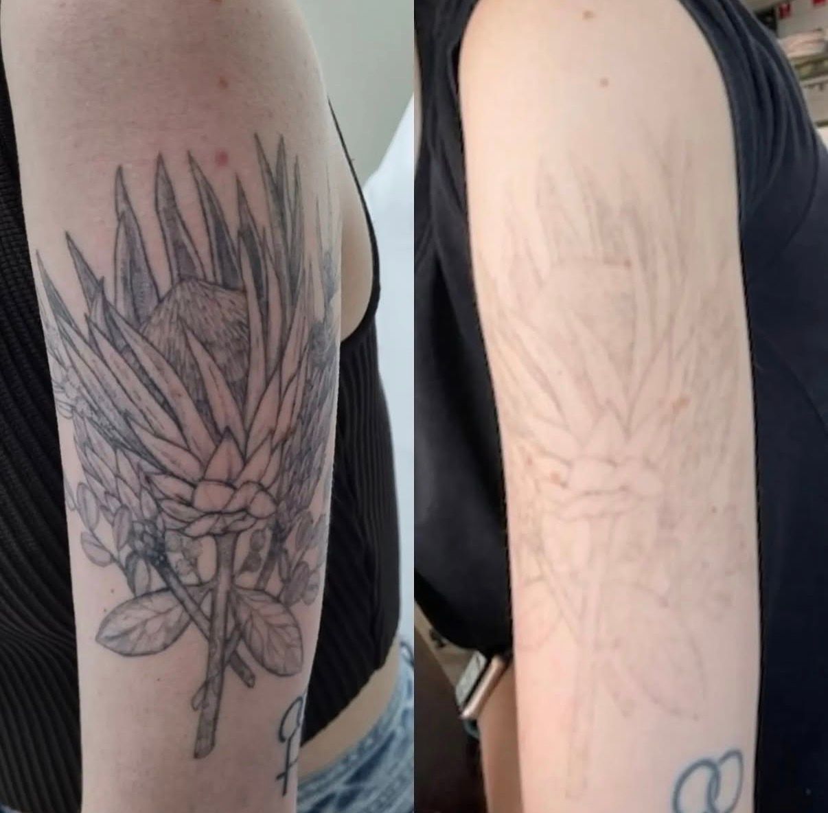 Arm tattoo design before and after: detailed flower sketch on the left, faint linework on the right — Laserpro Tattoo Removal in Shellharbour, NSW
