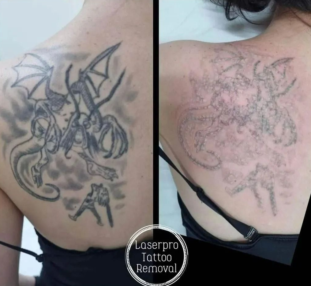 Before-and-after of a Shoulder Tattoo — Laserpro Tattoo Removal in Shellharbour, NSW