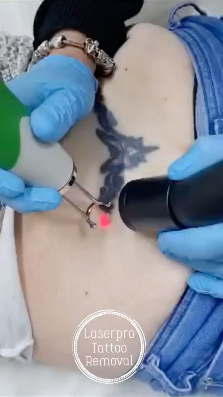Gloved Hands Using a Laser Device — Laserpro Tattoo Removal in Shellharbour, NSW
