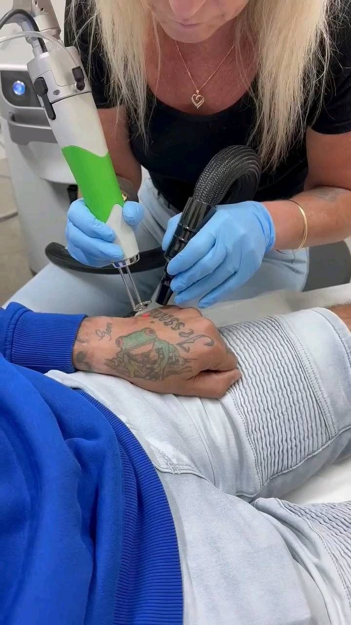 Person Getting a Tattoo Removed on a Hand — Laserpro Tattoo Removal in Shellharbour, NSW