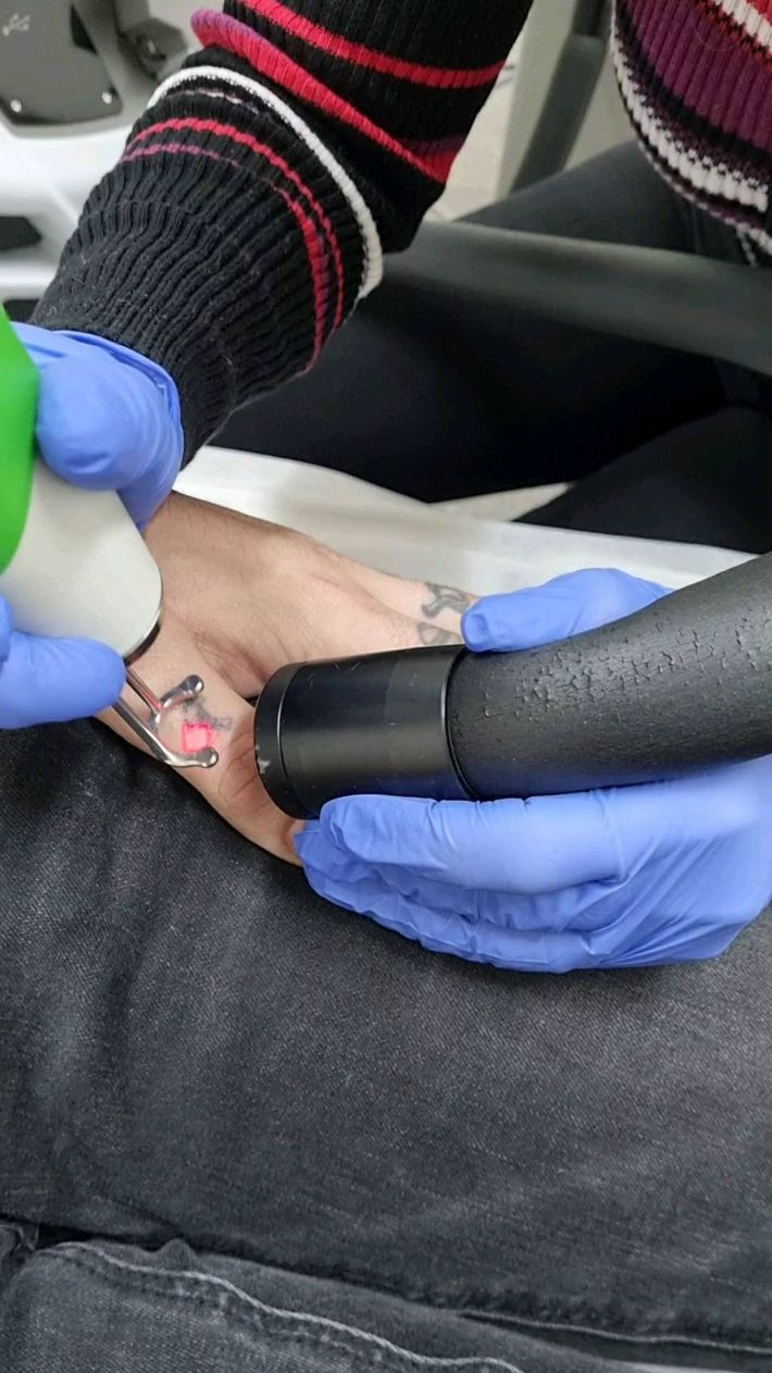 Gloved Hands Use a Handheld Device — Laserpro Tattoo Removal in Shellharbour, NSW
