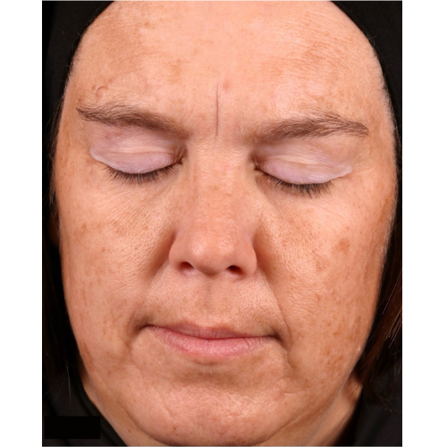 Face with closed eyes showing skin discoloration. Brown spots and uneven skin tone visible.