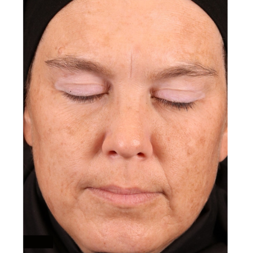 Woman with closed eyes, fair skin, and sun damage. Brown spots and wrinkles are visible on her face.