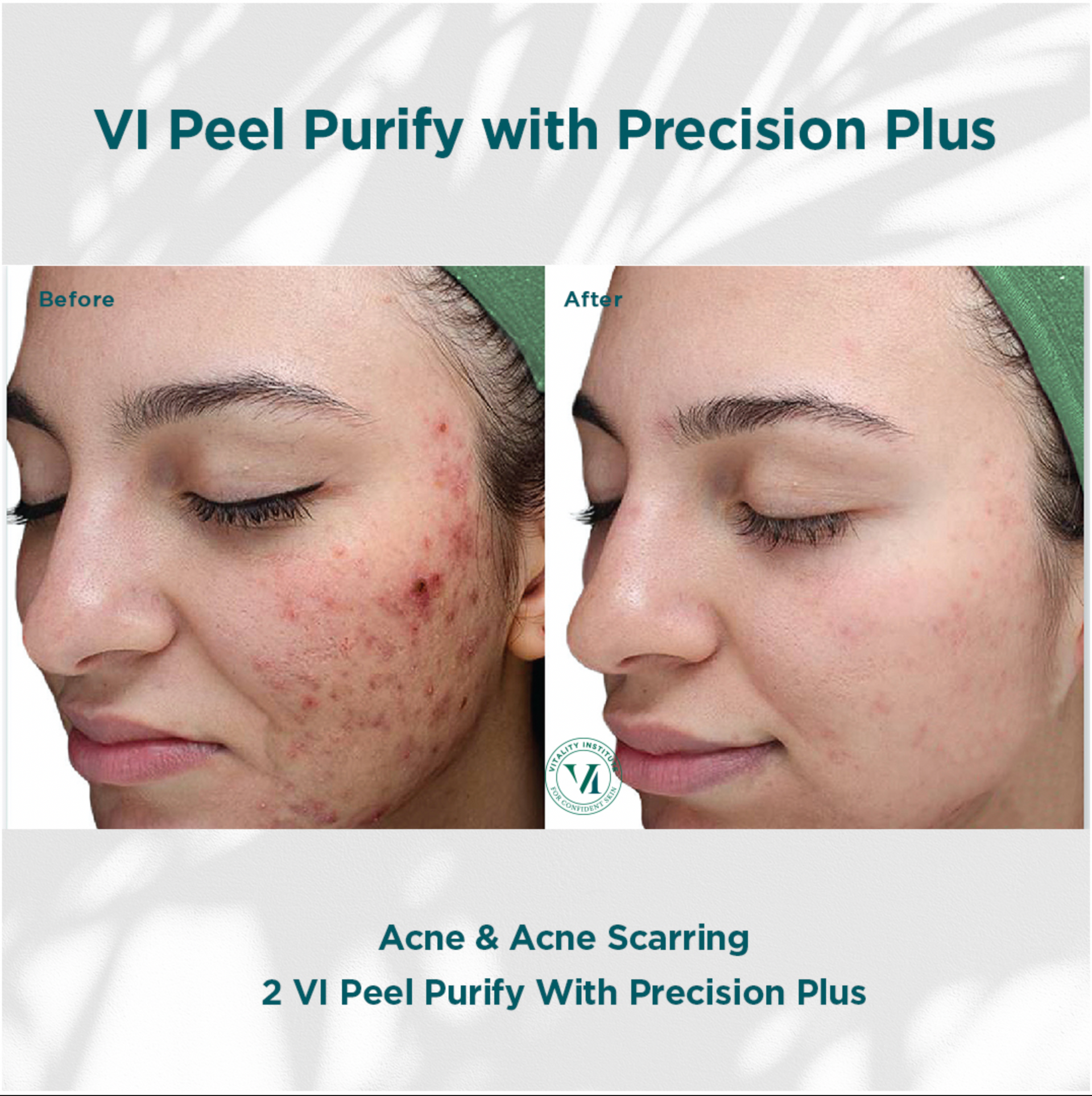 Before and after photos showing reduced acne and scarring after VI Peel Purify with Precision Plus.