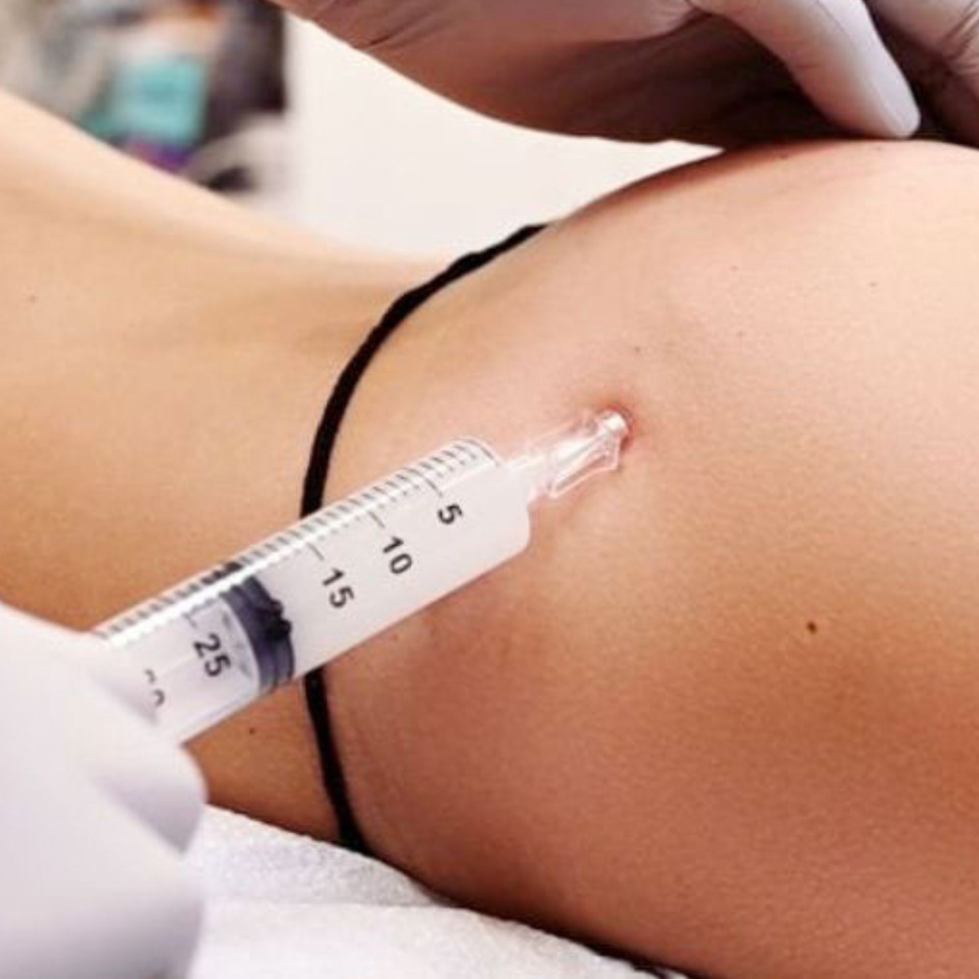 Syringe injecting a person’s upper arm during a medical procedure