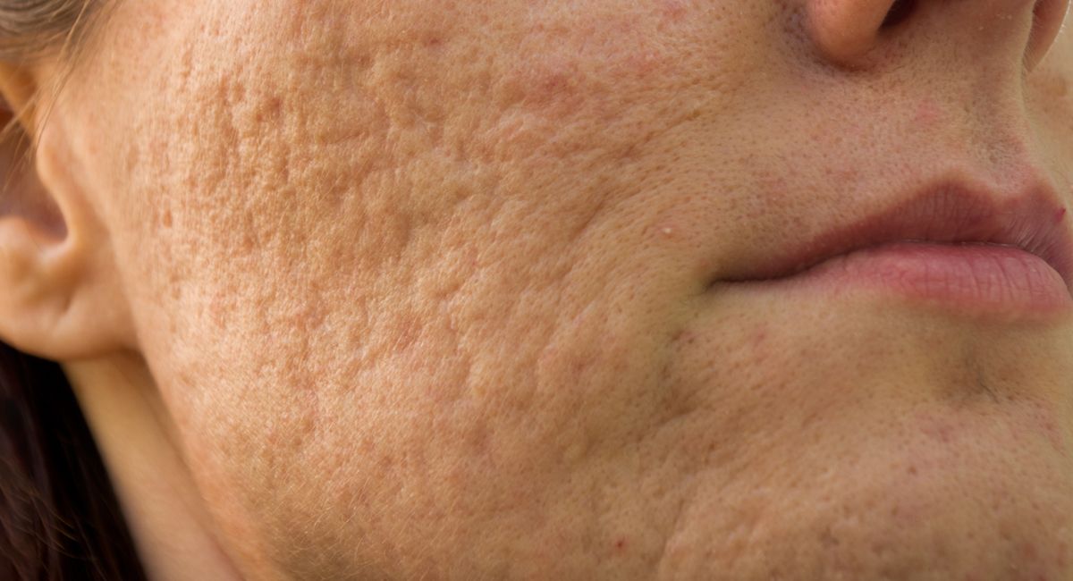 A close up of a woman 's face with acne on it.