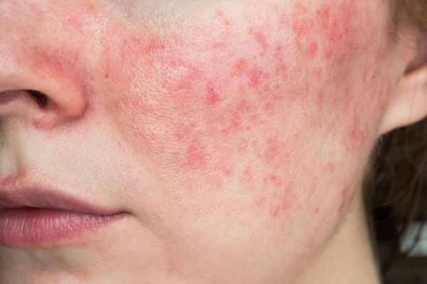A close up of a woman 's face with red spots on it.