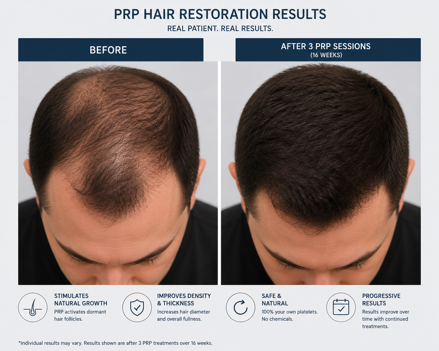 hair PRP before after results regrowth improvement