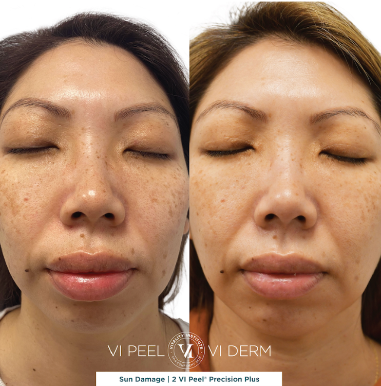 A before and after photo of a woman 's face with the words vi peel vi derm in the corner