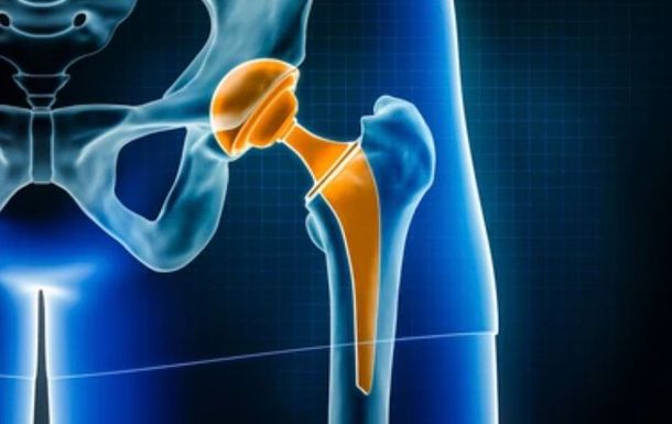 Hip Replacement | David Agolley Orthopaedic Surgeon