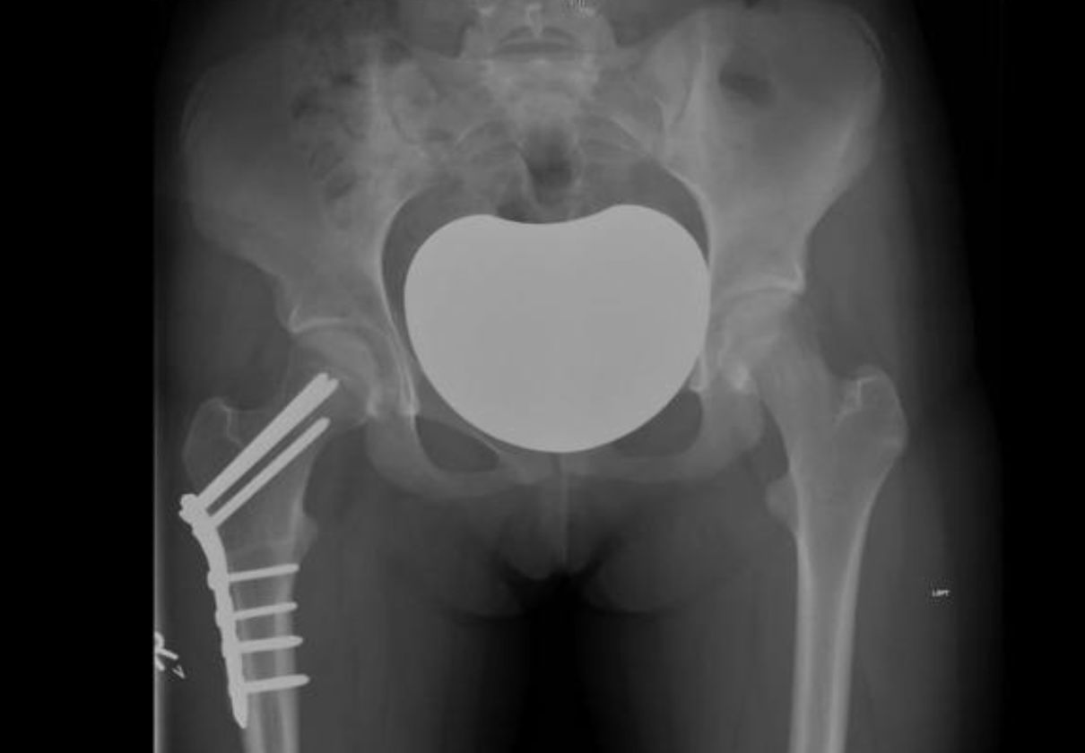 Femoral Derotation Osteotomy operations on the Gold Coast | Dr David Agolley Orthopaedic Surgeon