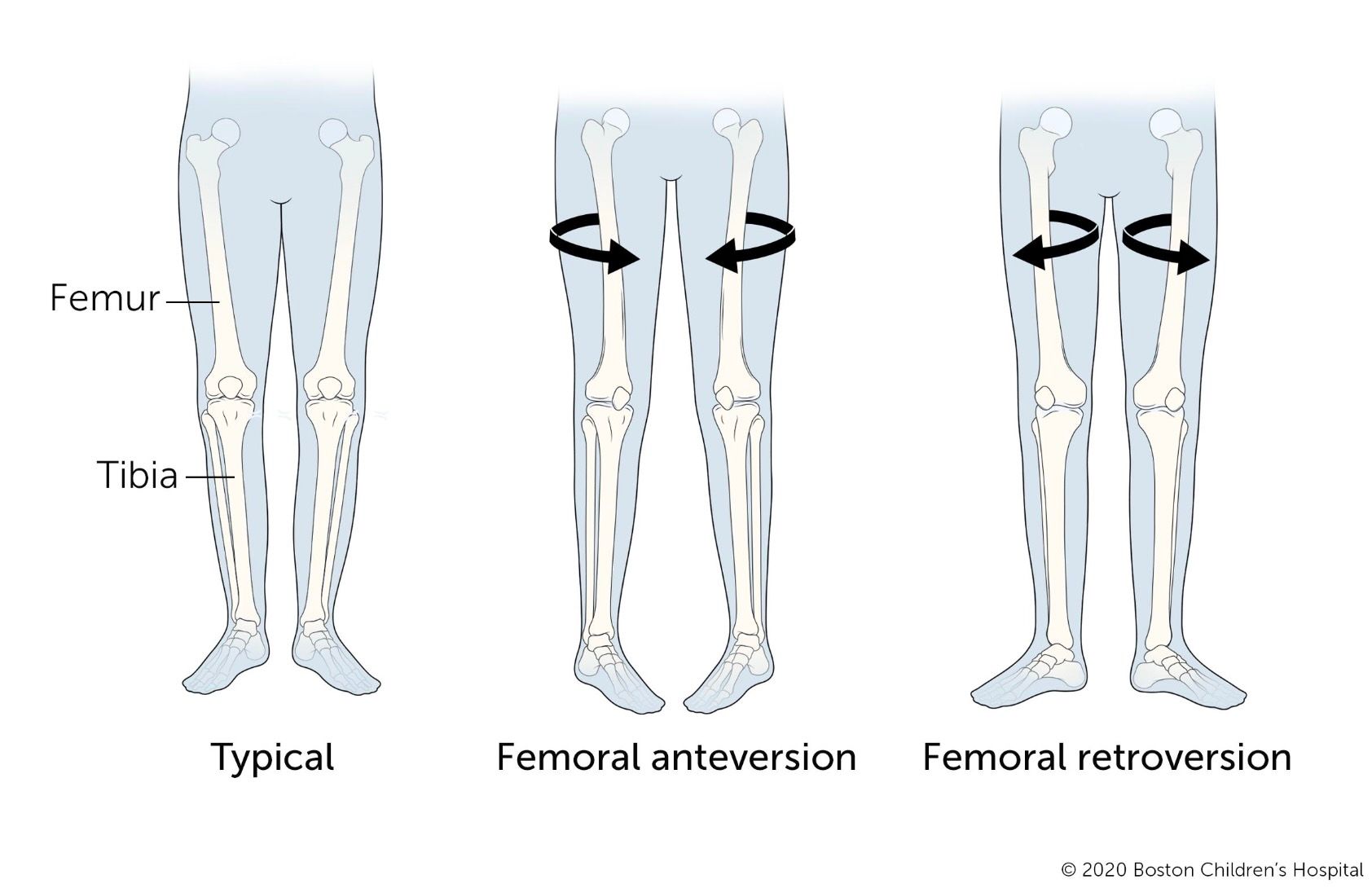 Symptoms of Abnormal Femoral Rotation & Femoral Version | David Agolley Orthopaedic Surgeon