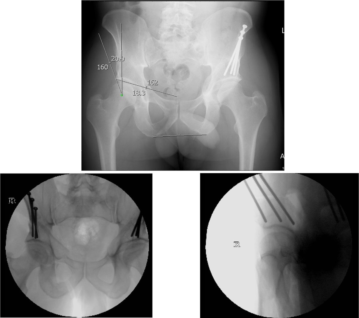 Hip Dysplasia PAO | David Agolley Orthopaedic Surgeon