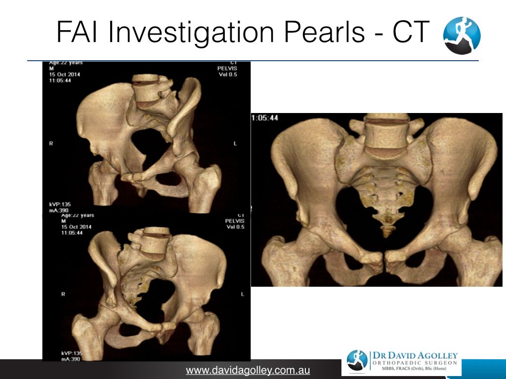 FAI Investigation Pearls - CT | Dr David Agolley Orthopaedic Surgeon
