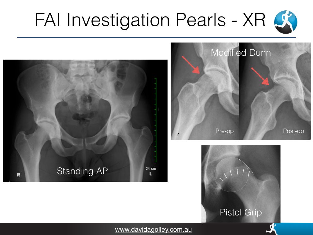 FAI Investigation Pearls - XR | Dr David Agolley Orthopaedic Surgeon
