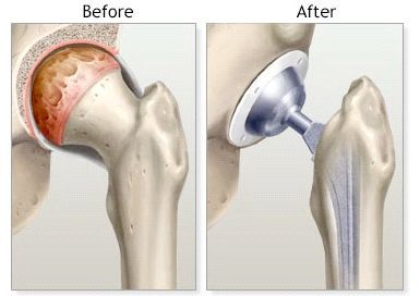 Hip Replacement In Tugun | David Agolley Orthopaedic Surgeon