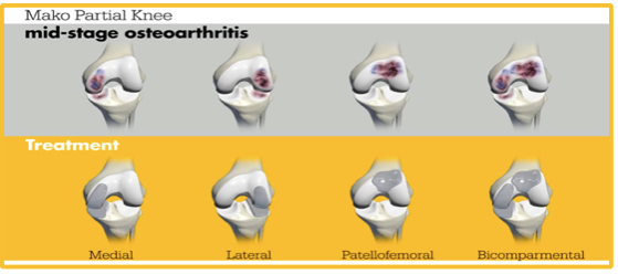 What is the Difference between total and partial knee replacement? | David Agolley Orthopaedic Surgeon