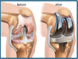 Knee Replacement Surgeon In Tugun | David Agolley Orthopaedic Surgeon