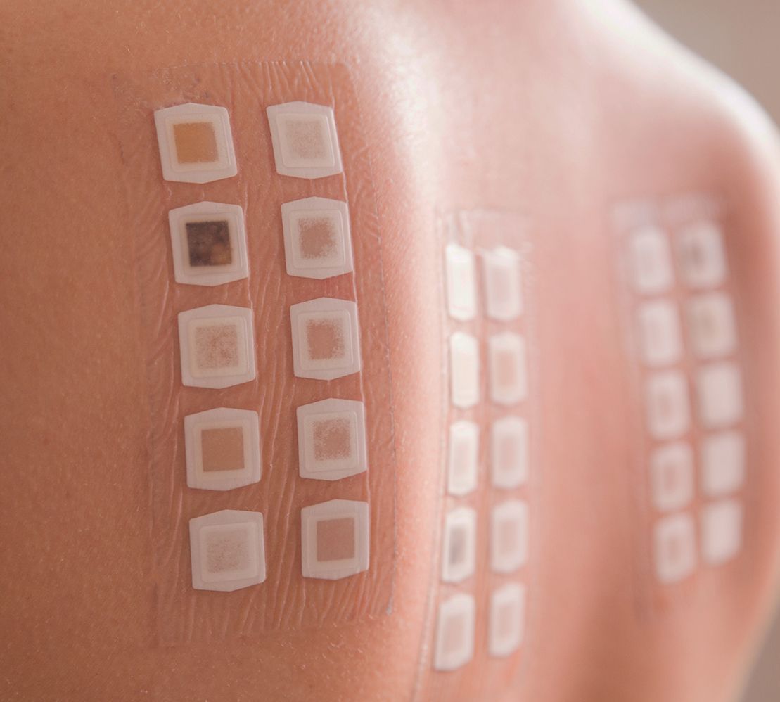 A close up of a person 's back with stickers on it checking for allergens 