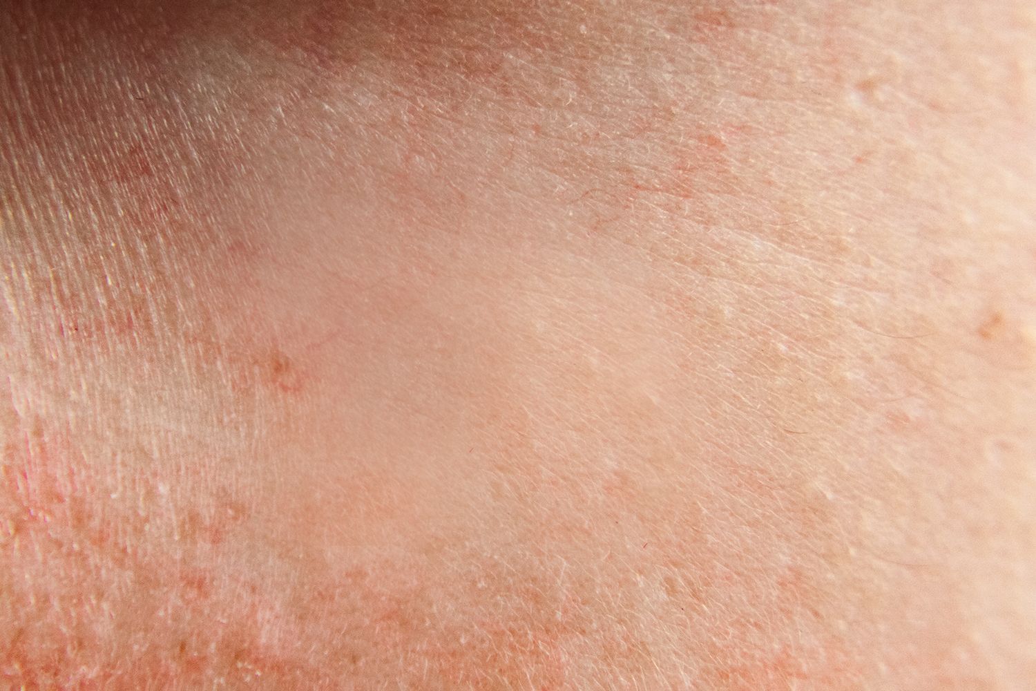 A close up of a person 's skin with a red spot on it.
