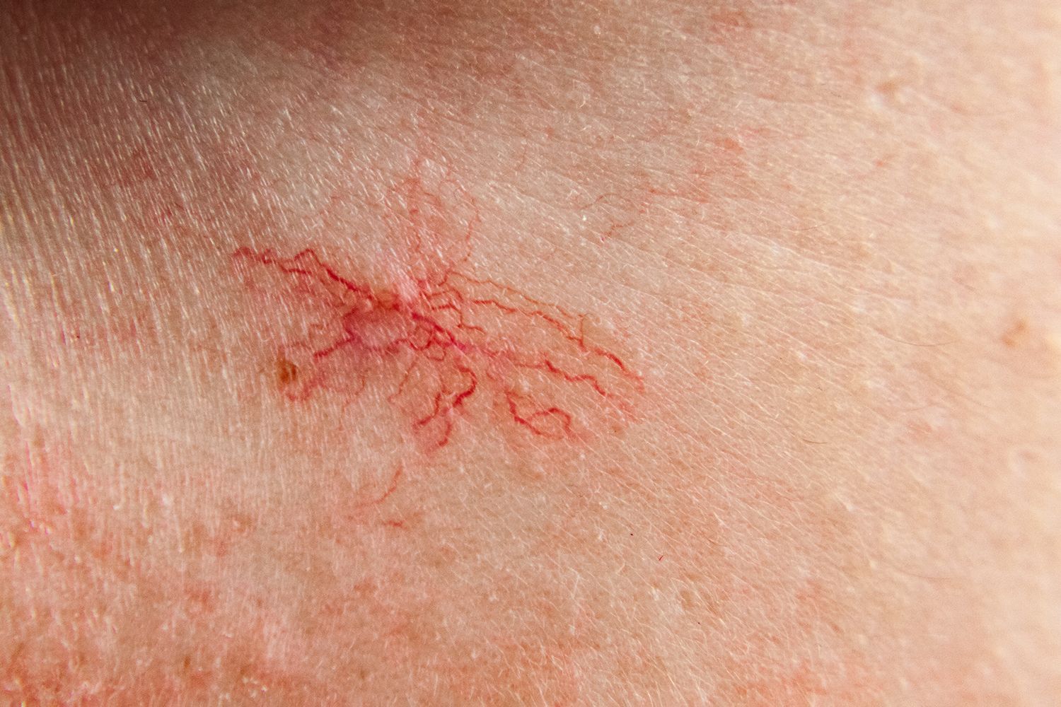 A close up of a person 's skin with spider veins.