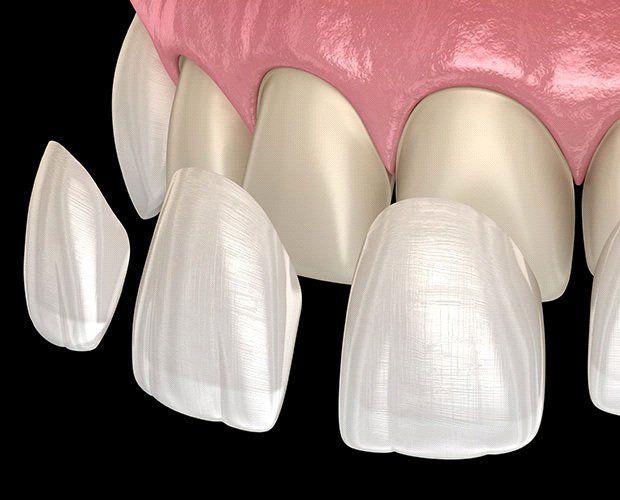 Un primo piano dei denti di una persona con faccette in porcellana.
