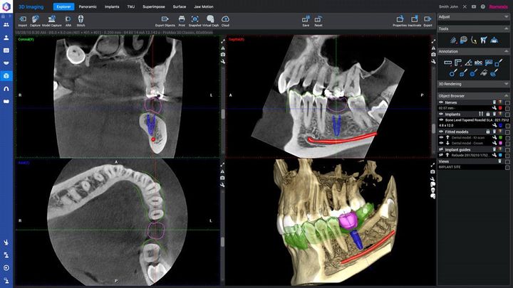 Sullo schermo di un computer viene mostrata una TAC dei denti di una persona.