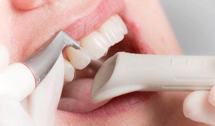 Una donna si sta facendo pulire i denti dal dentista.