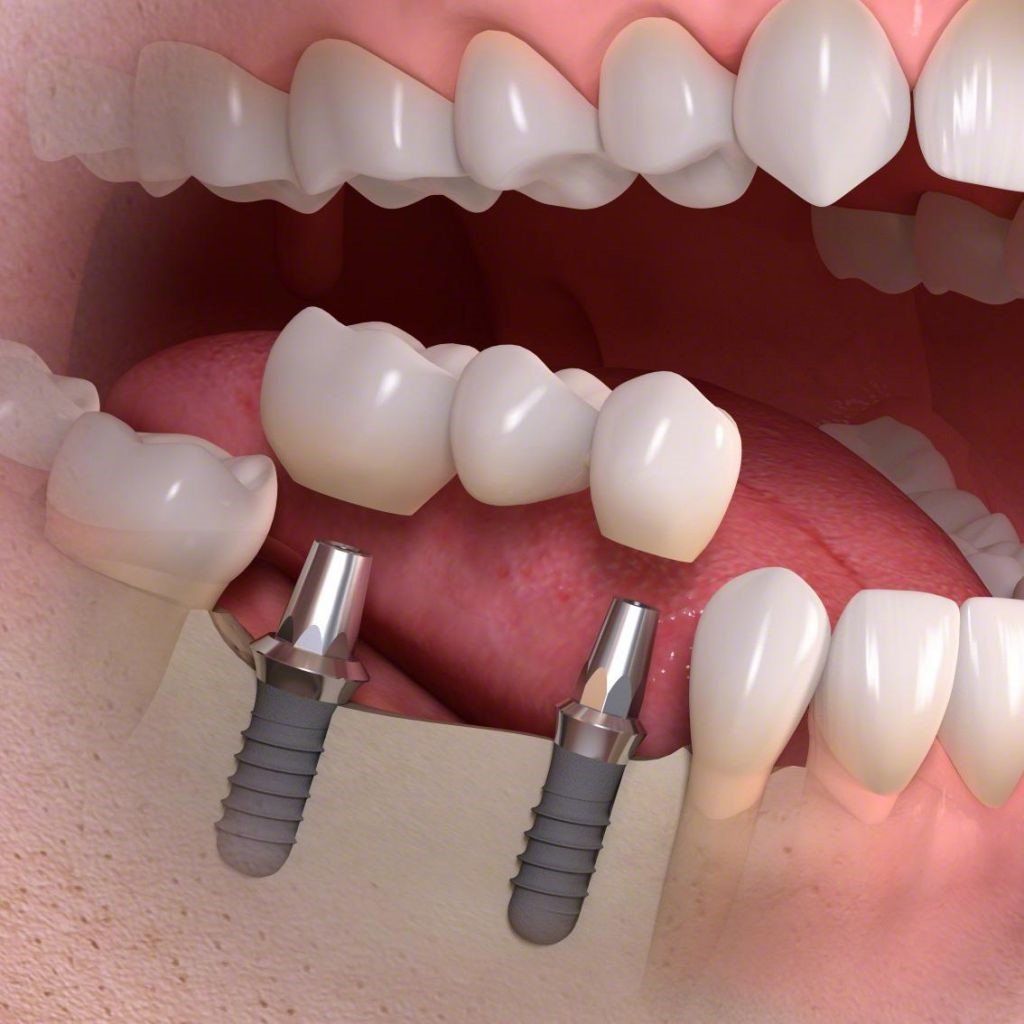 Un primo piano della bocca di una persona con due impianti dentali al suo interno