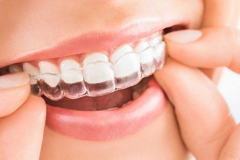 Primo piano di una persona che indossa un apparecchio ortodontico invisibile.