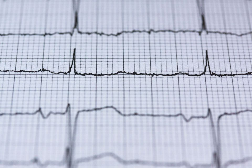 Close-up of an ECG monitor strip showing repeating heart rhythm spikes on graph paper