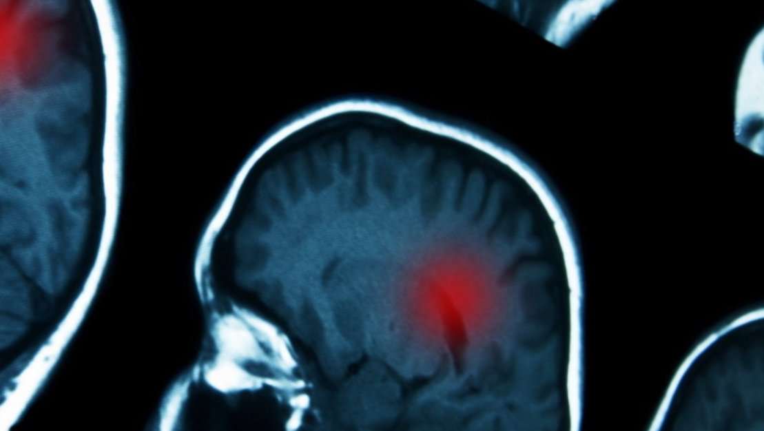 Especialista neuro-oncologista em Curitiba