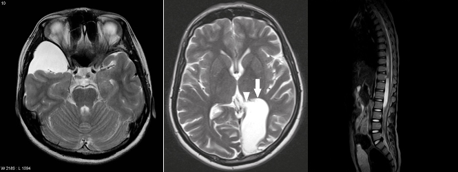 Imagens de Ressonância Magnética demonstrando cistos aracnóides em diferentes localidades do cérebro e medula.