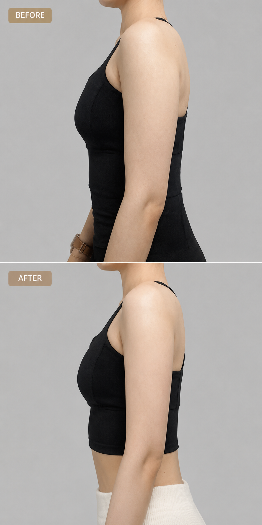 Arm liposuction bingo wing before and after