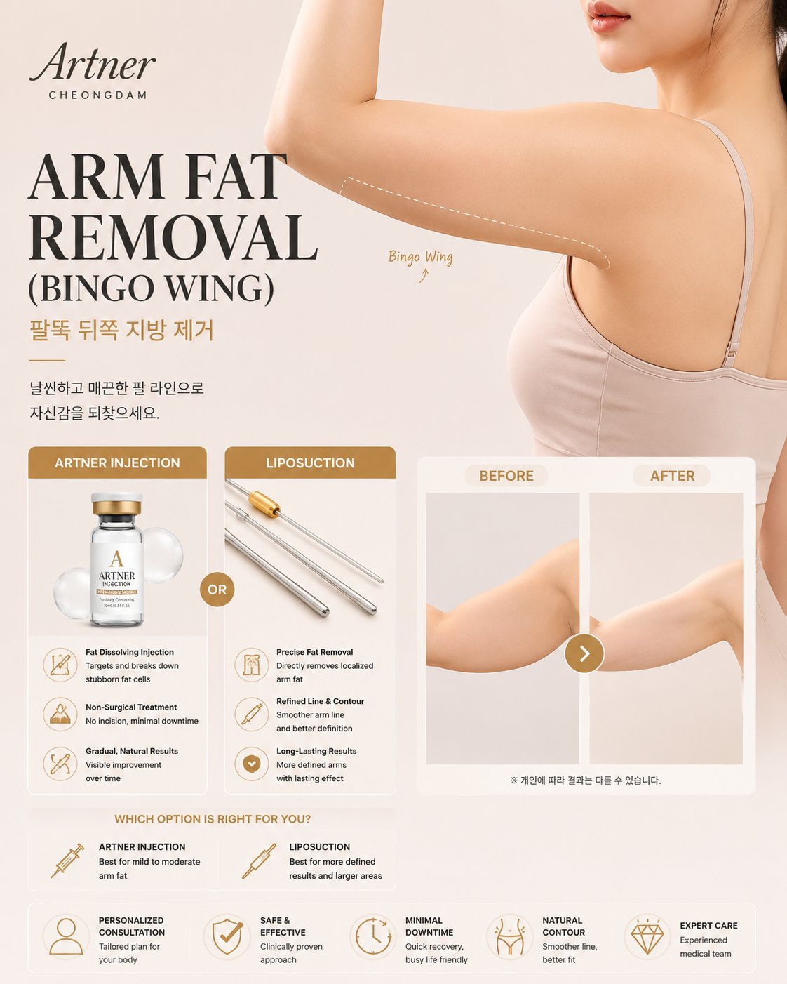 Arm contouring at ARTNER Cheongdam