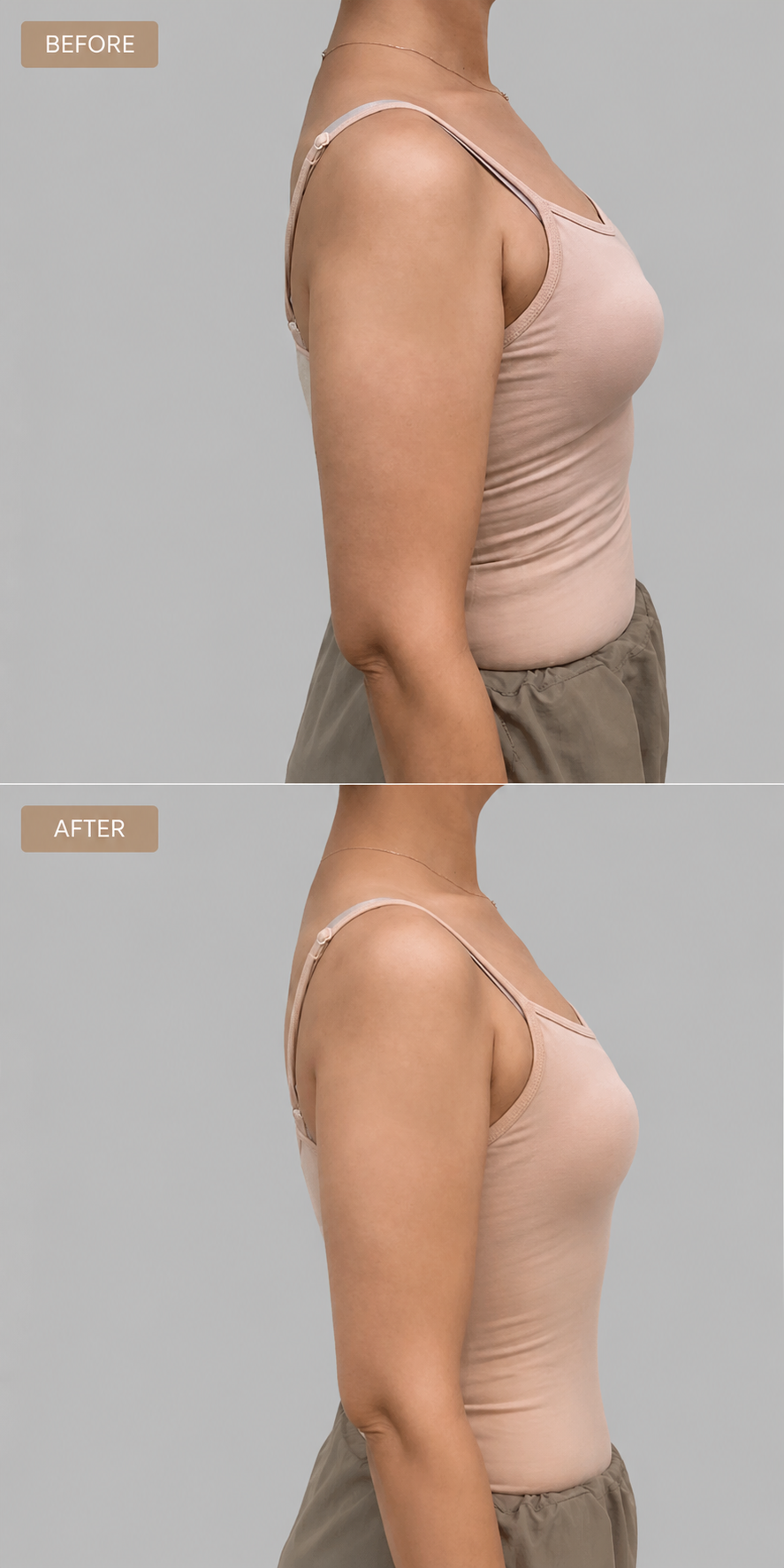 Bra line side fat dissolving before and after
