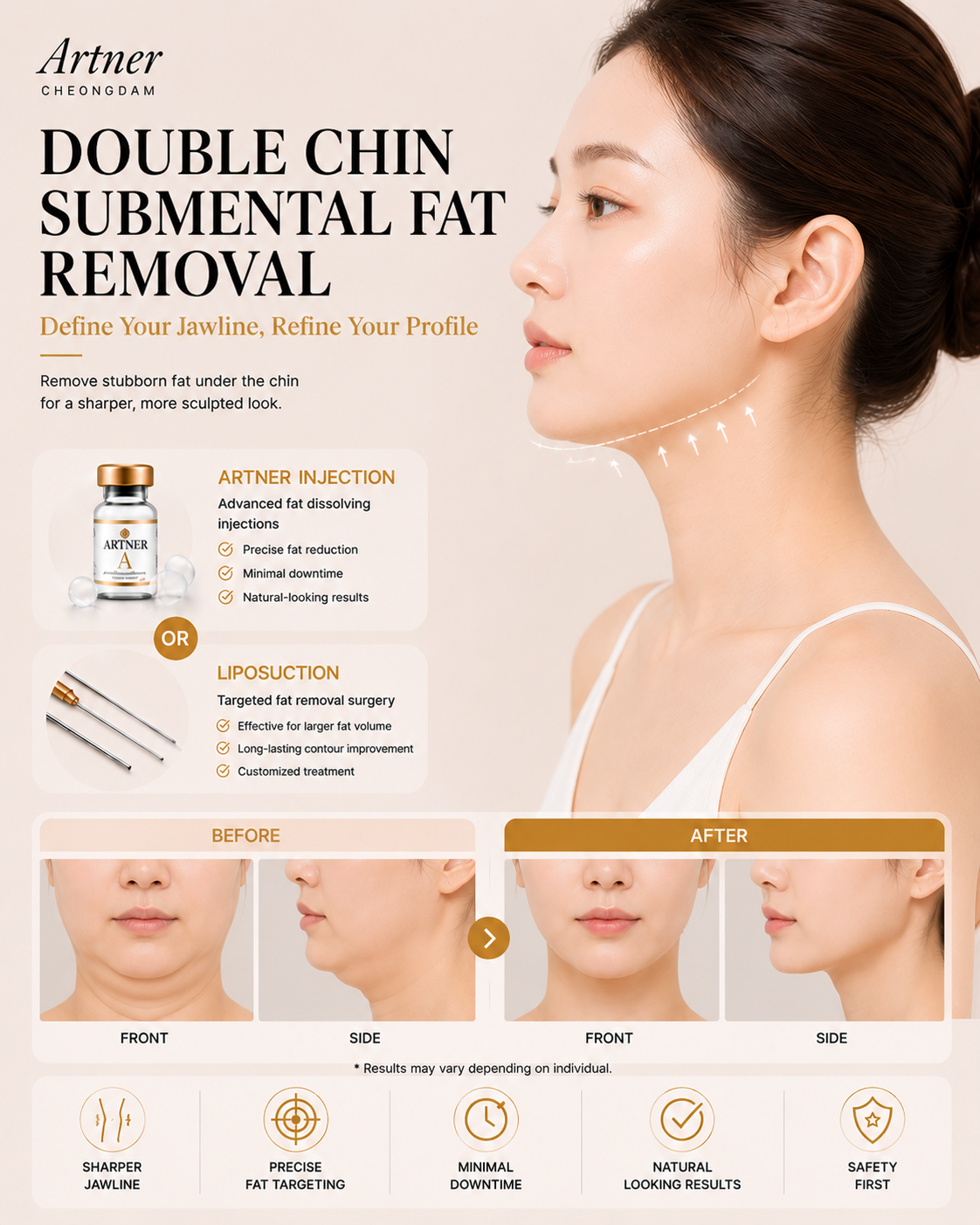 Double chin contouring at ARTNER Cheongdam