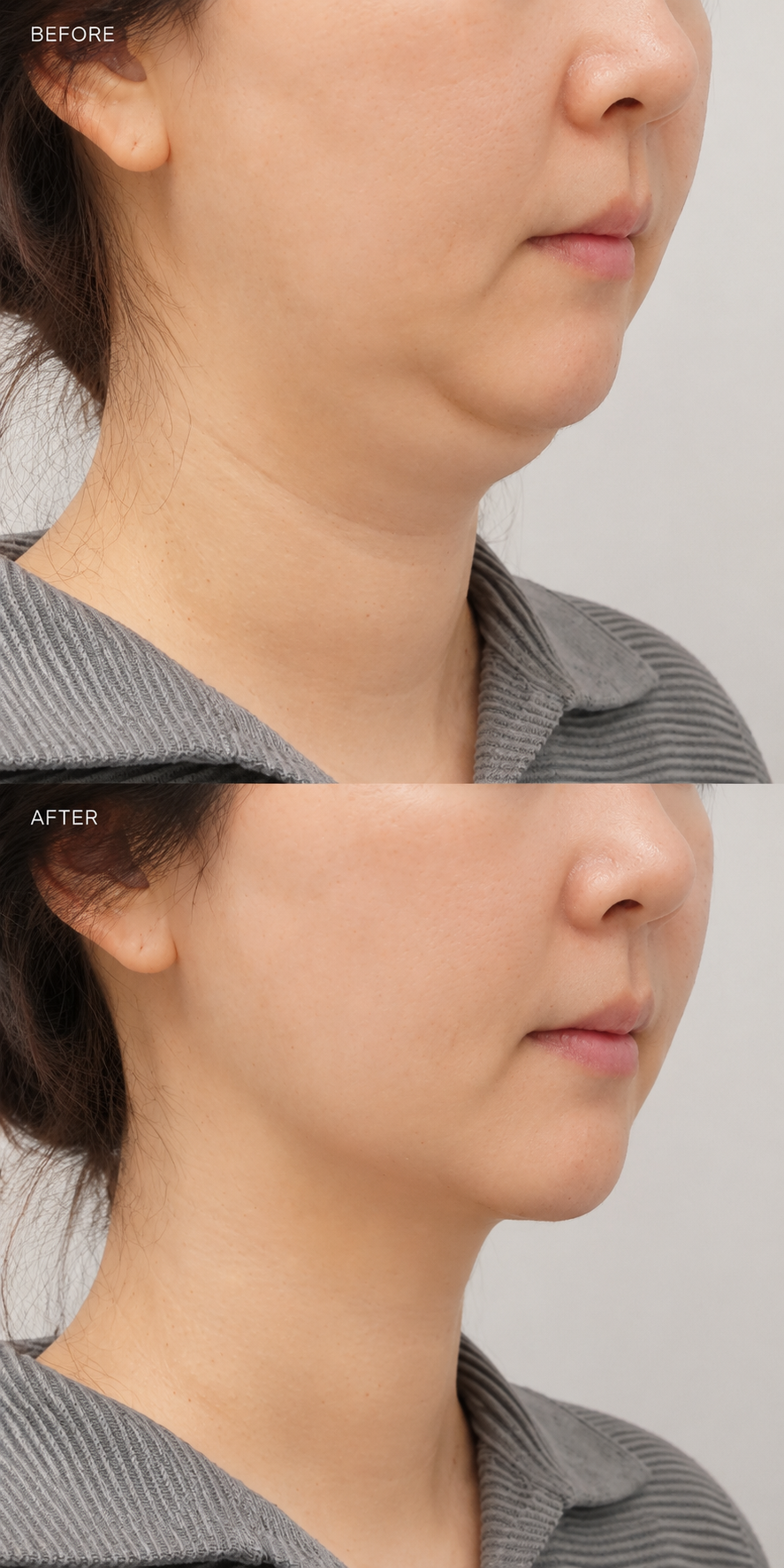 Double chin and face refinement before and after