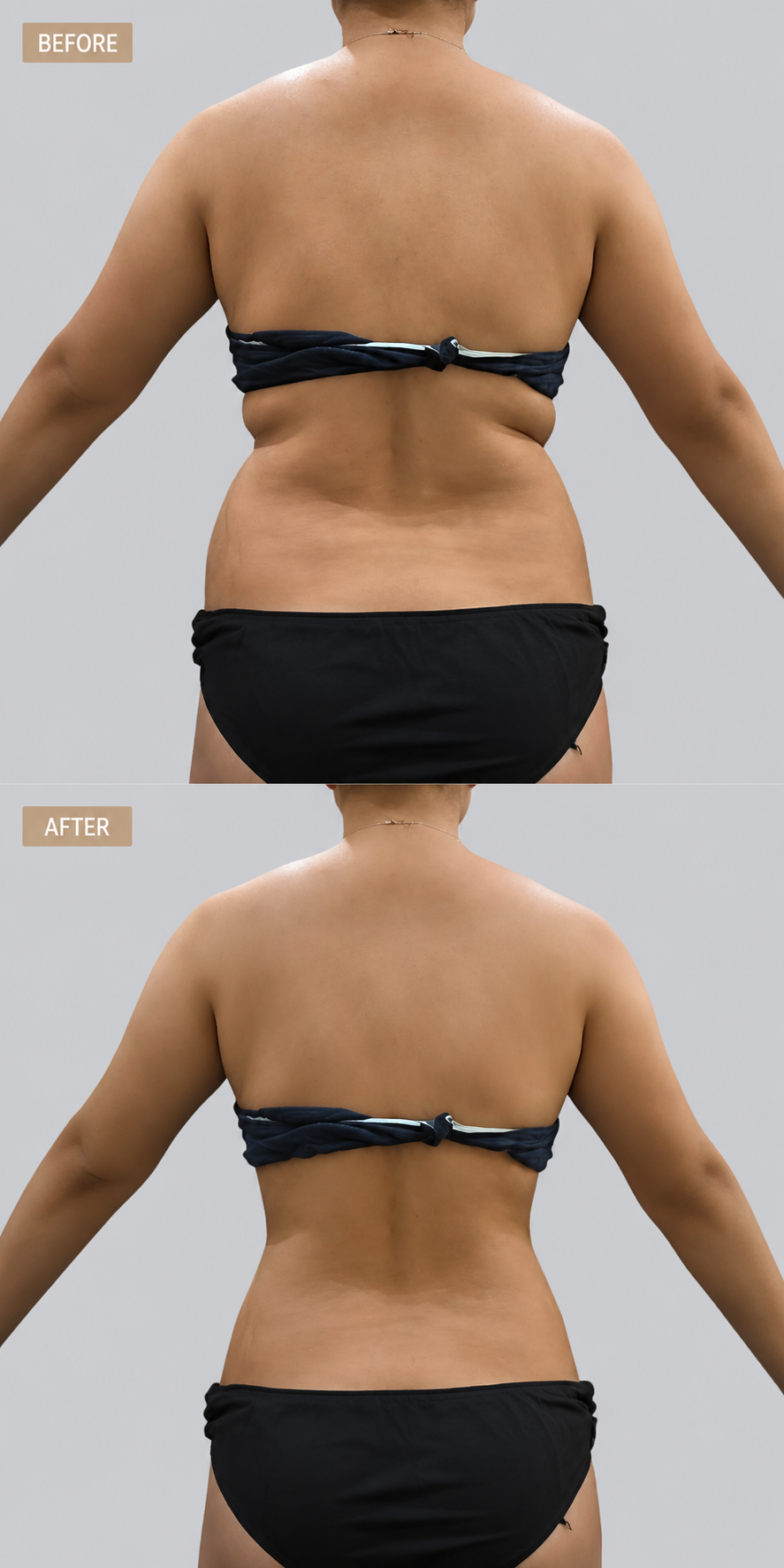 Back and bra line liposuction before and after