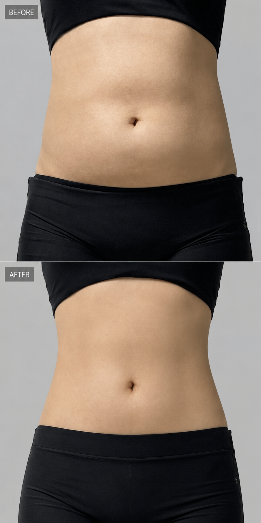 ART-FAT abdomen before and after at ARTNER Cheongdam