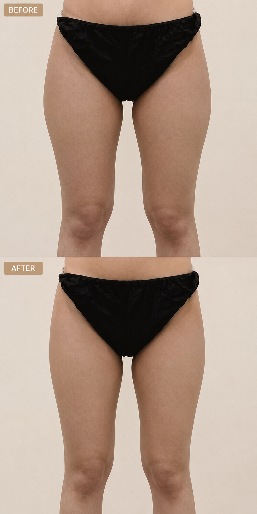 ART-FAT lower abdomen and mons pubis before and after at ARTNER Cheongdam, Gangnam