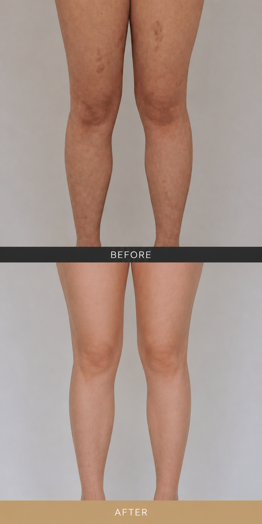 Inner and outer thigh liposuction before and after